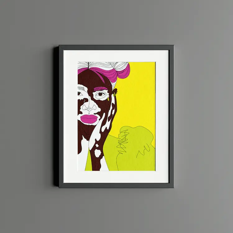 Vitiligo (Limited edition)